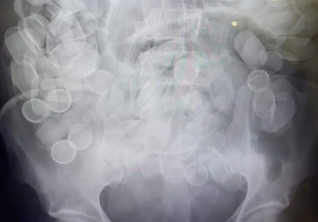 Al borde de la muerte al viajar con 1,5 kilos de cocaína dentro de su cuerpo