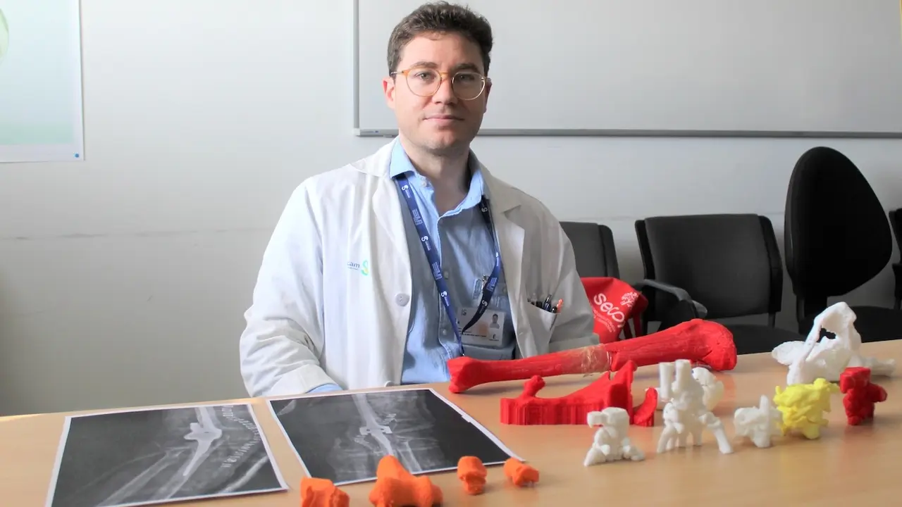 Los traumatólogos del Hospital General Universitario de Ciudad Real utilizan la impresión 3D para reproducir fielmente el hueso del paciente y planificar la intervención