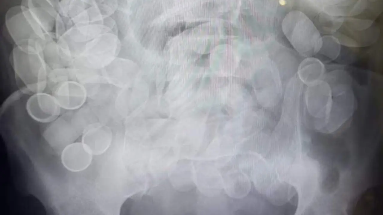 Al borde de la muerte al viajar con 1,5 kilos de cocaína dentro de su cuerpo