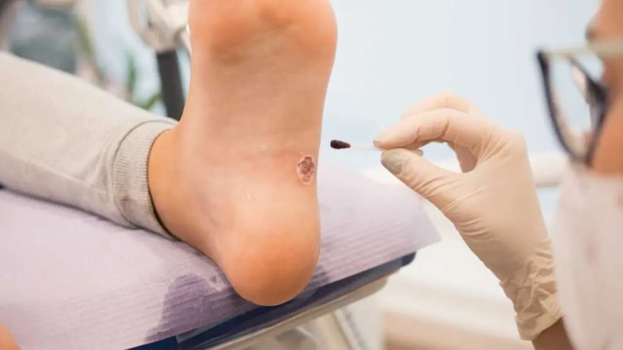 Un profesional sanitario examina una verruga plantar en la planta del pie de un paciente. La nueva t&eacute;cnica desarrollada por la UCLM permite diagnosticar el virus causante de estas lesiones en menos de tres horas mediante escamas de piel de la propia lesi&oacute;n.